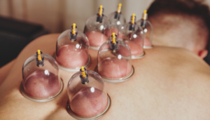 Dry Cupping and Dry Needling in Dubai